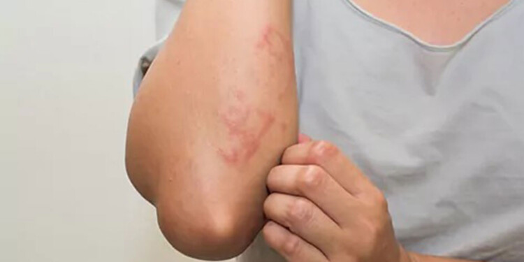  Dermatitis Atópica: sugerencias para tratar esta enfermedad crónica pero no contagiosa